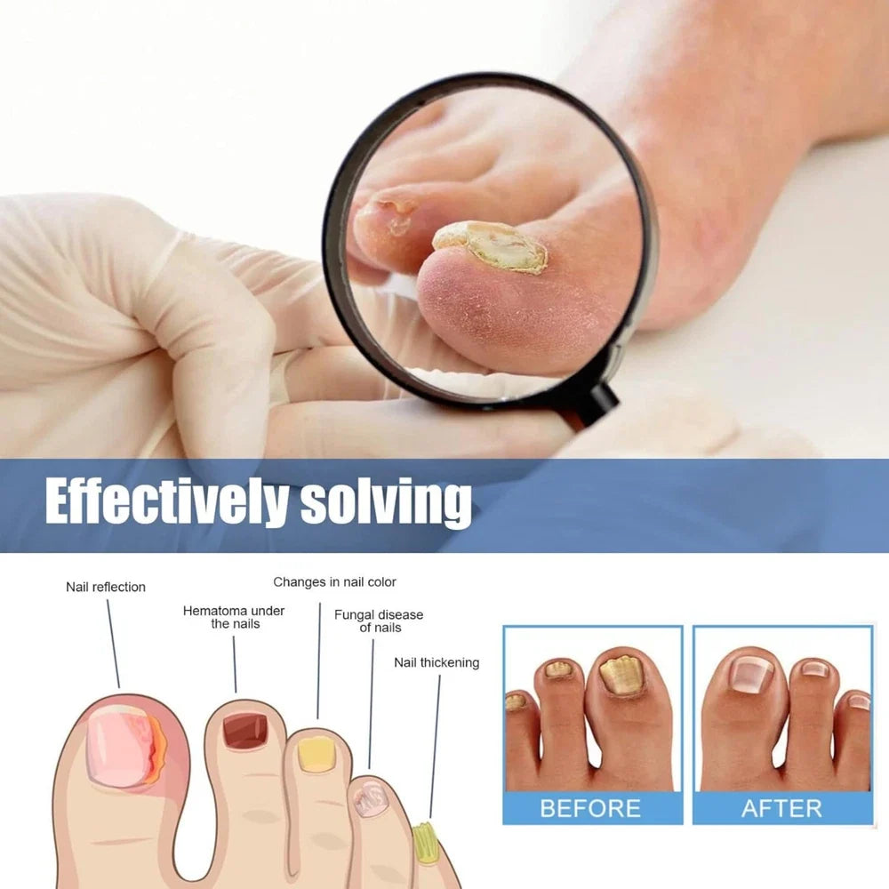 60 Pcs - Extra Strength Fungal Nail Patches, 60 Pcs Toenail Treatment for Nail Care