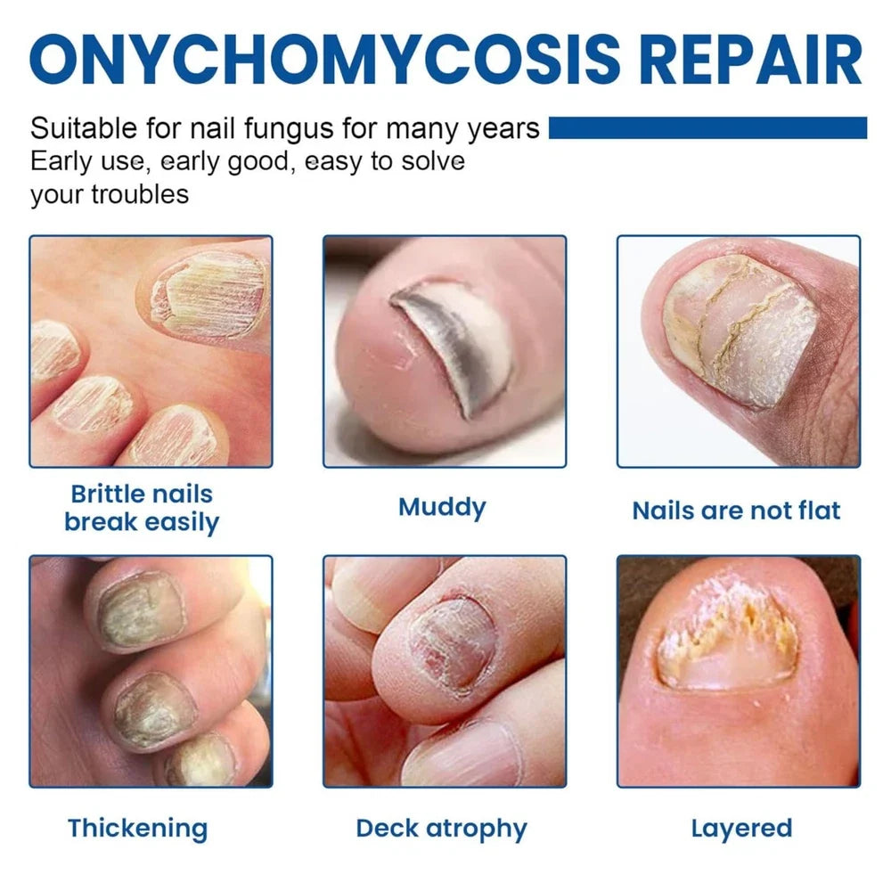60 Pcs - Extra Strength Fungal Nail Patches, 60 Pcs Toenail Treatment for Nail Care